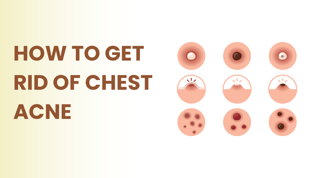 how to get rid of chest acne